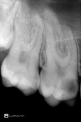 Ząb przed leczeniem kanałowym. RTG zęba.