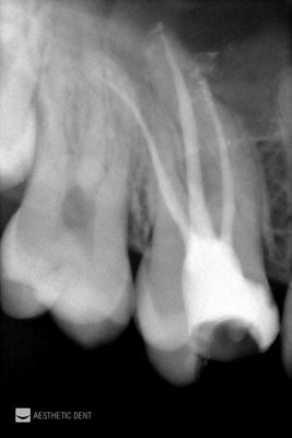 Ząb po leczeniu kanałowym. Widoczne opracowane kanały zęba. RTG zęba.