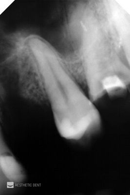 Złamany ząb — konieczność leczenia kanałowego. RTG zęba.