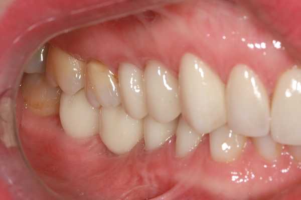 Zaprojektowane korony protetyczne w jamie ustnej pacjenta