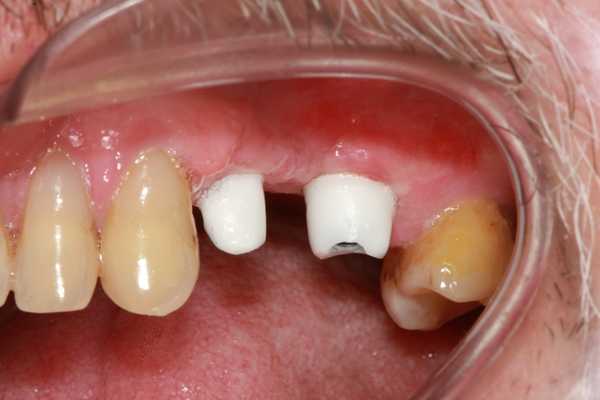Brak kilku zębów uzupełniony implantami
